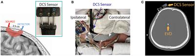 Microvascular cerebral blood flow response to intrathecal nicardipine is associated with delayed cerebral ischemia